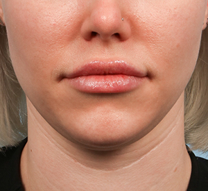 Lip Filler 1 After Image