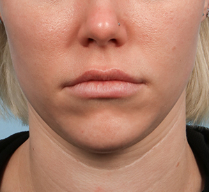 Lip Filler 1 Before Image
