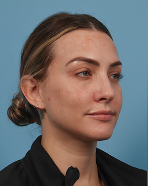 Cheek Filler 1 Before Image