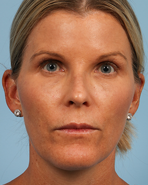 Laser Treatment 2 After Image