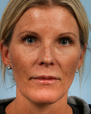 Laser Treatment 2 Before Image