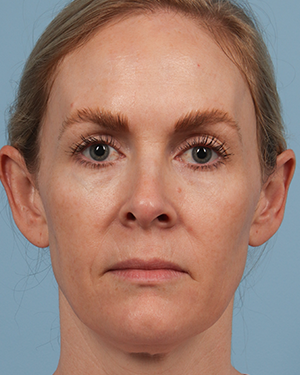 Laser Treatment 1 After Image