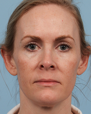 Laser Treatment 1 Before Image