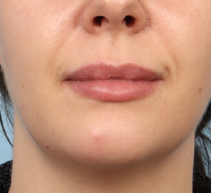 Lip Filler 2 After Image