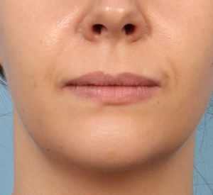 Lip Filler 2 Before Image