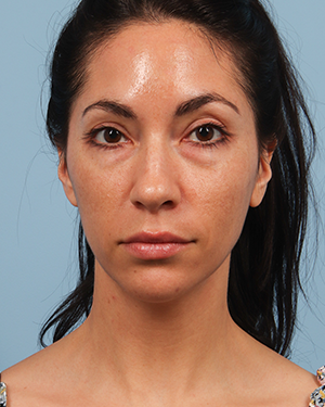Tear Trough Filler 2 Before Image