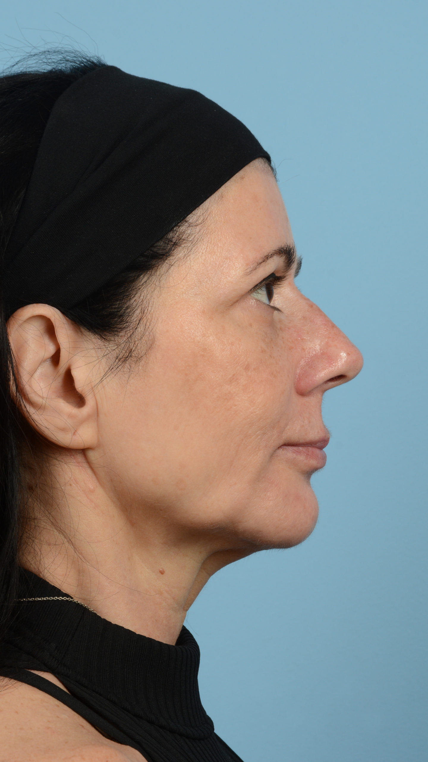 Faceshape 2 After Image