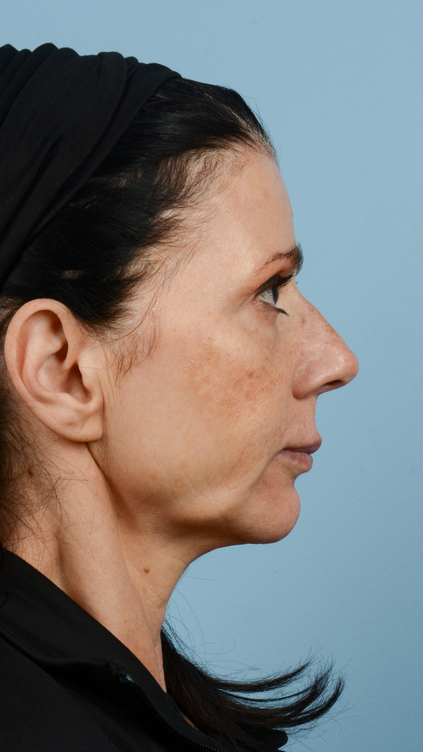 Faceshape 2 Before Image
