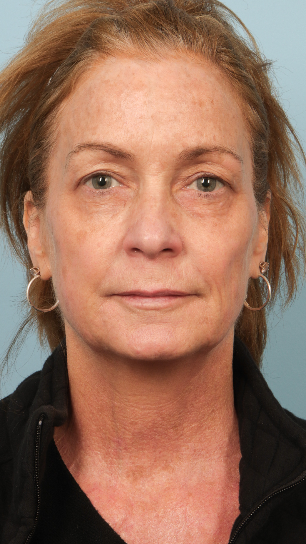 Faceshape 1 After Image
