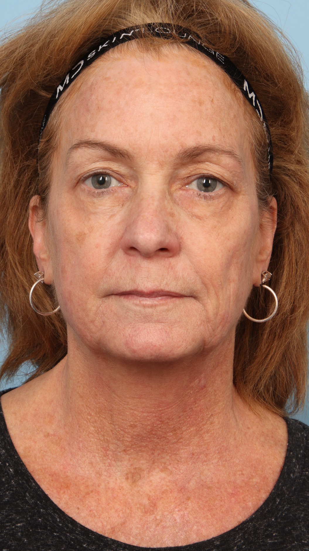 Faceshape 1 Before Image