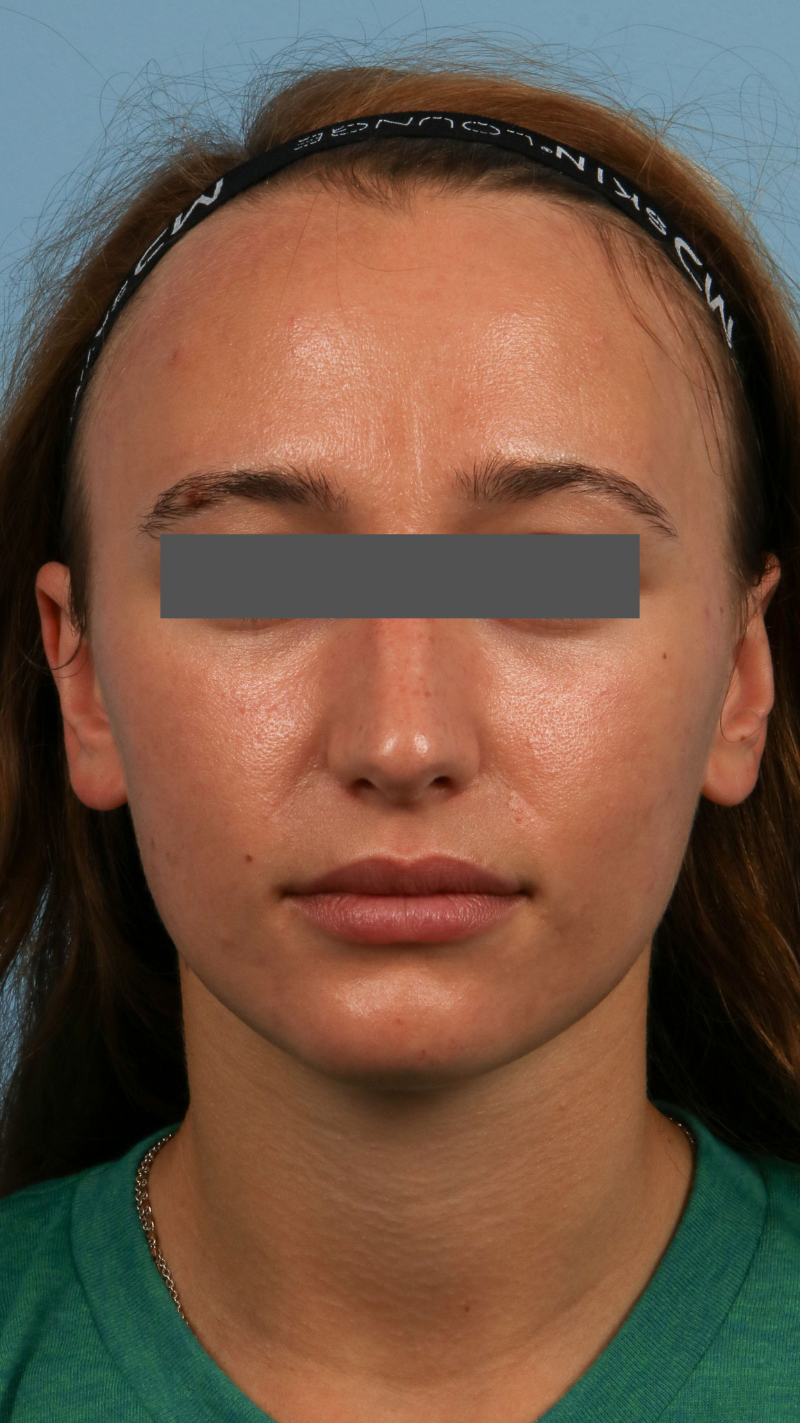 Skin Rejuvenation 1 After Image