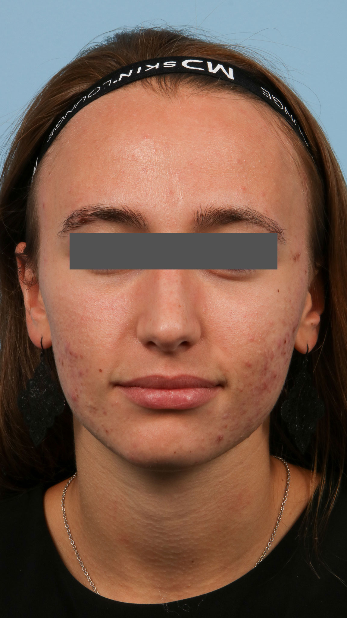 Skin Rejuvenation 1 Before Image