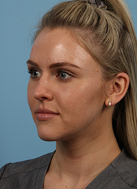 Faceshape 3 After Image