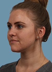 Faceshape 3 Before Image