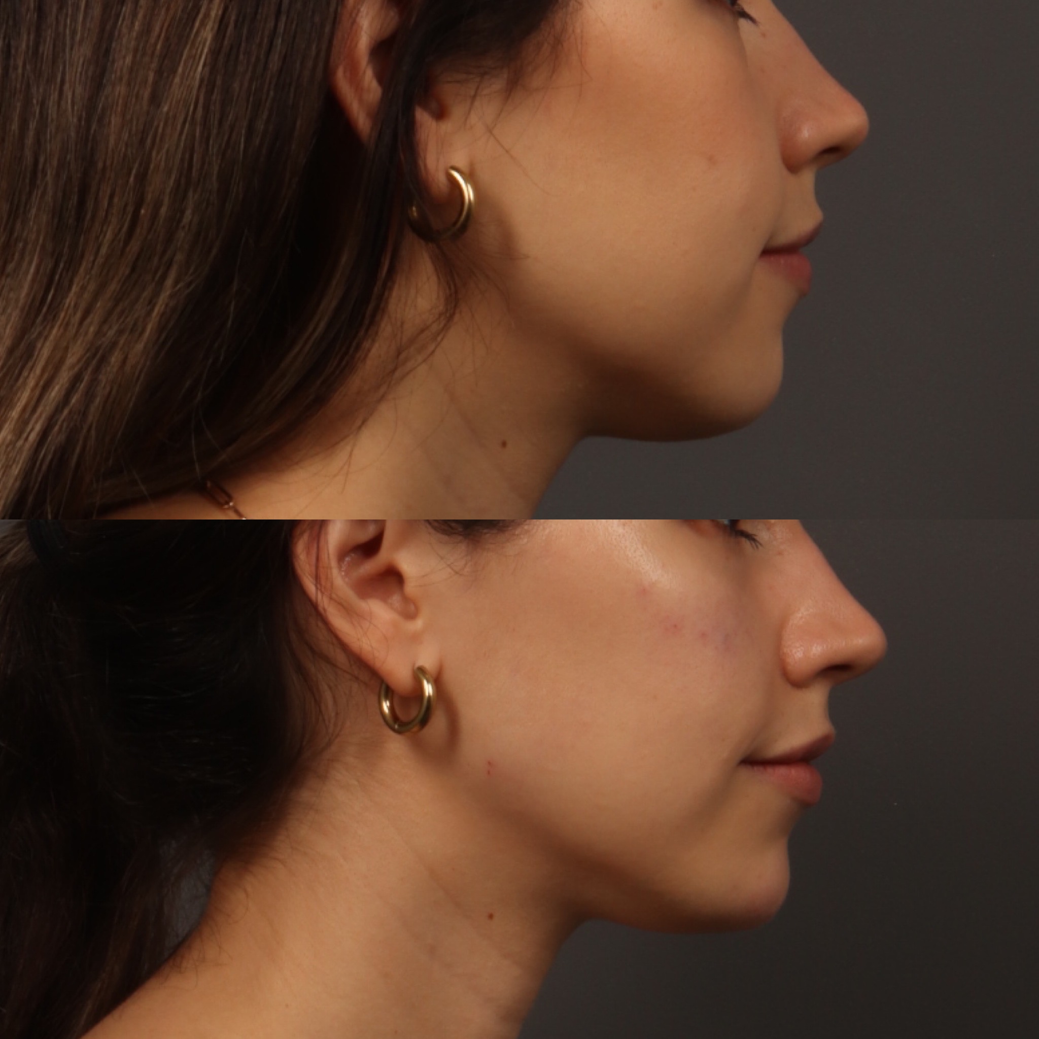 Cheek Filler 2 Marge Image