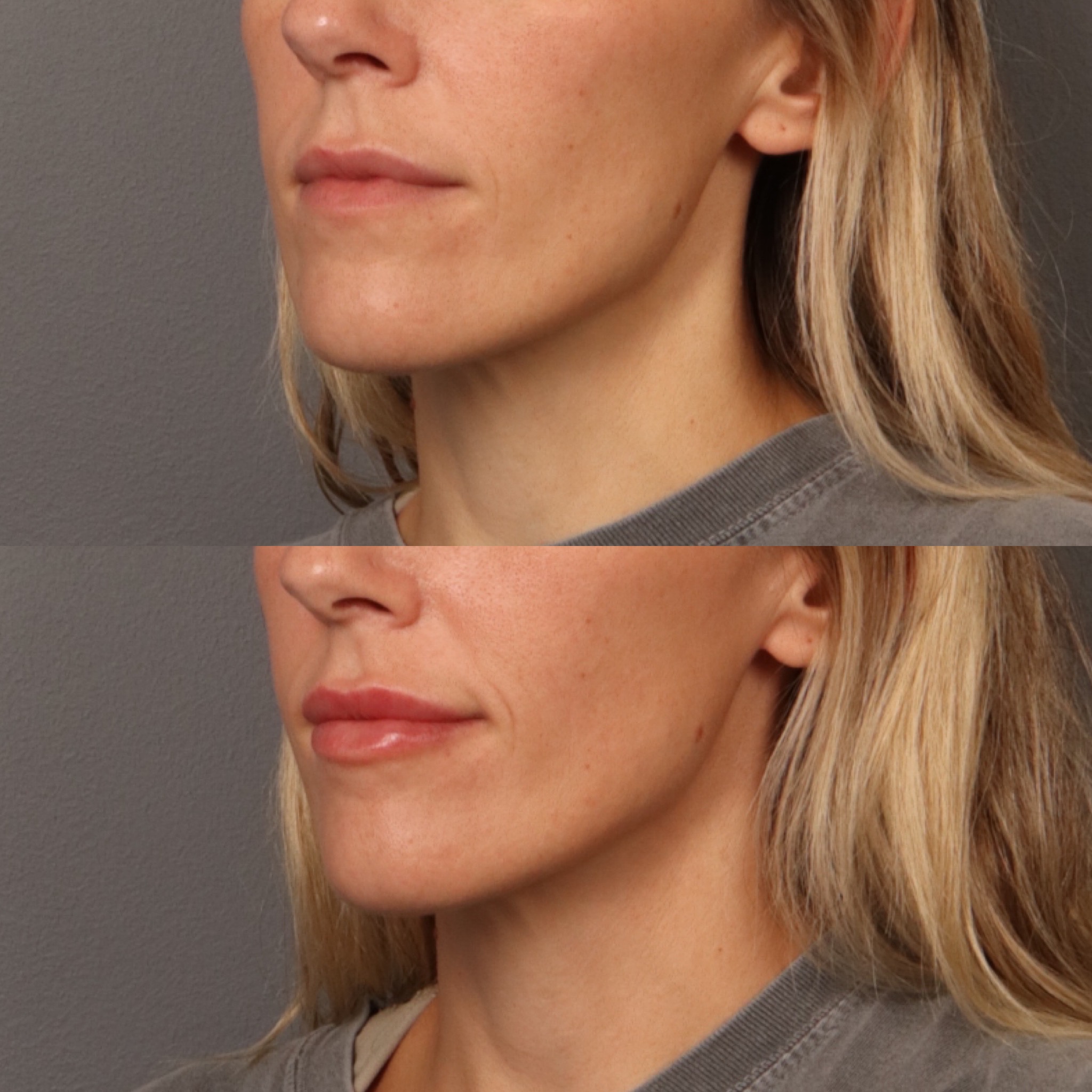Lip Filler 3 Marge Image