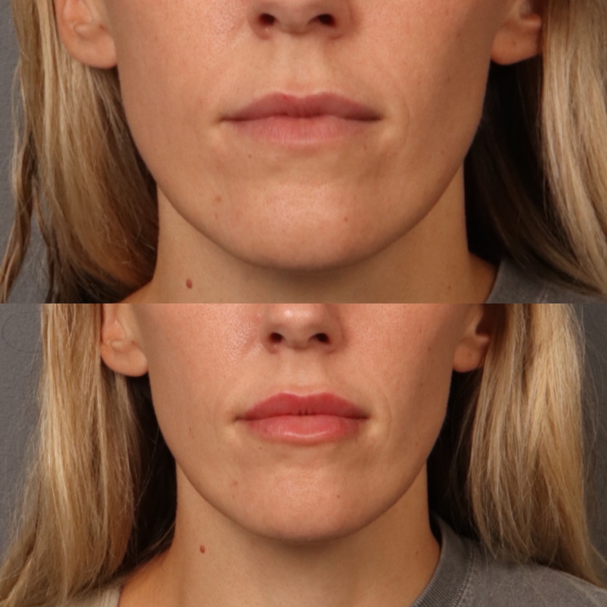 Lip Filler 3 Marge Image