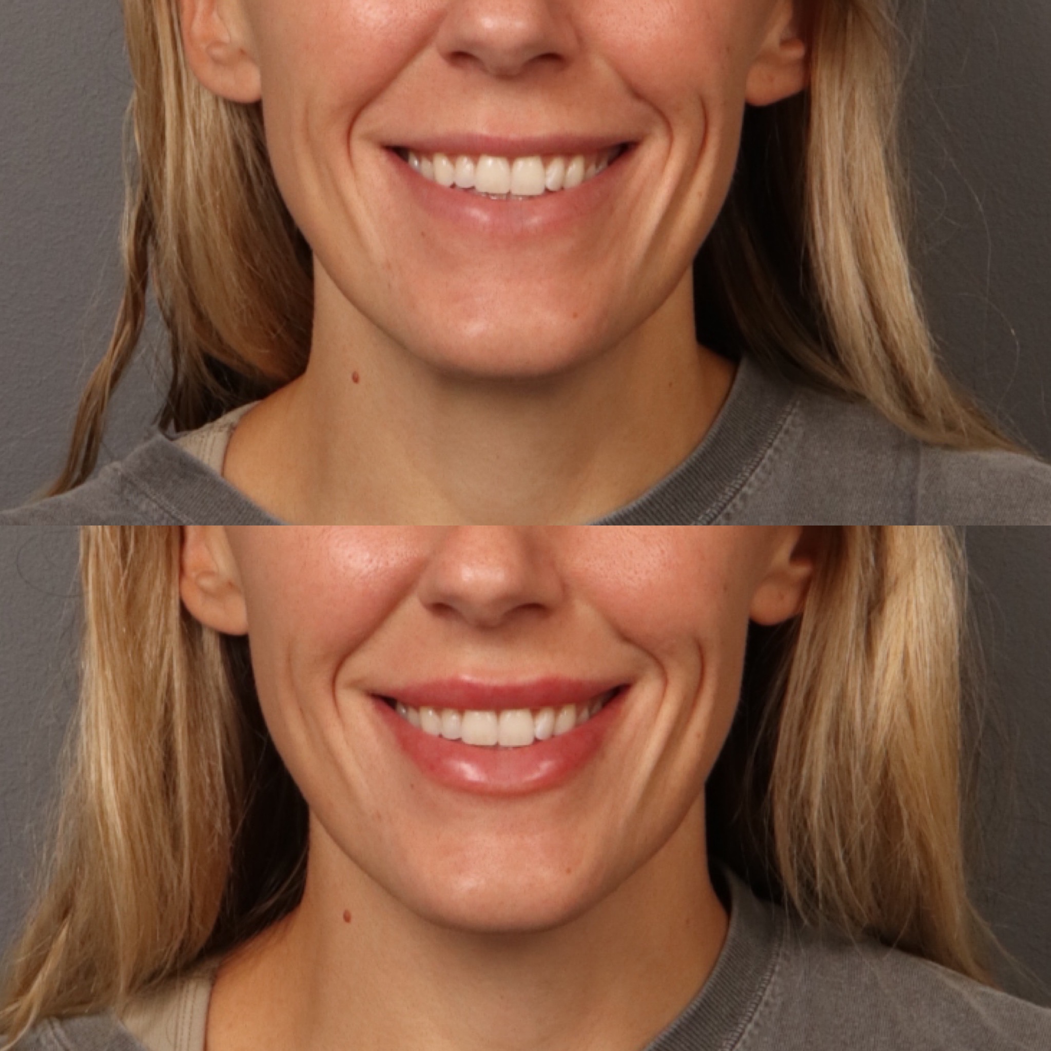Lip Filler 3 Marge Image