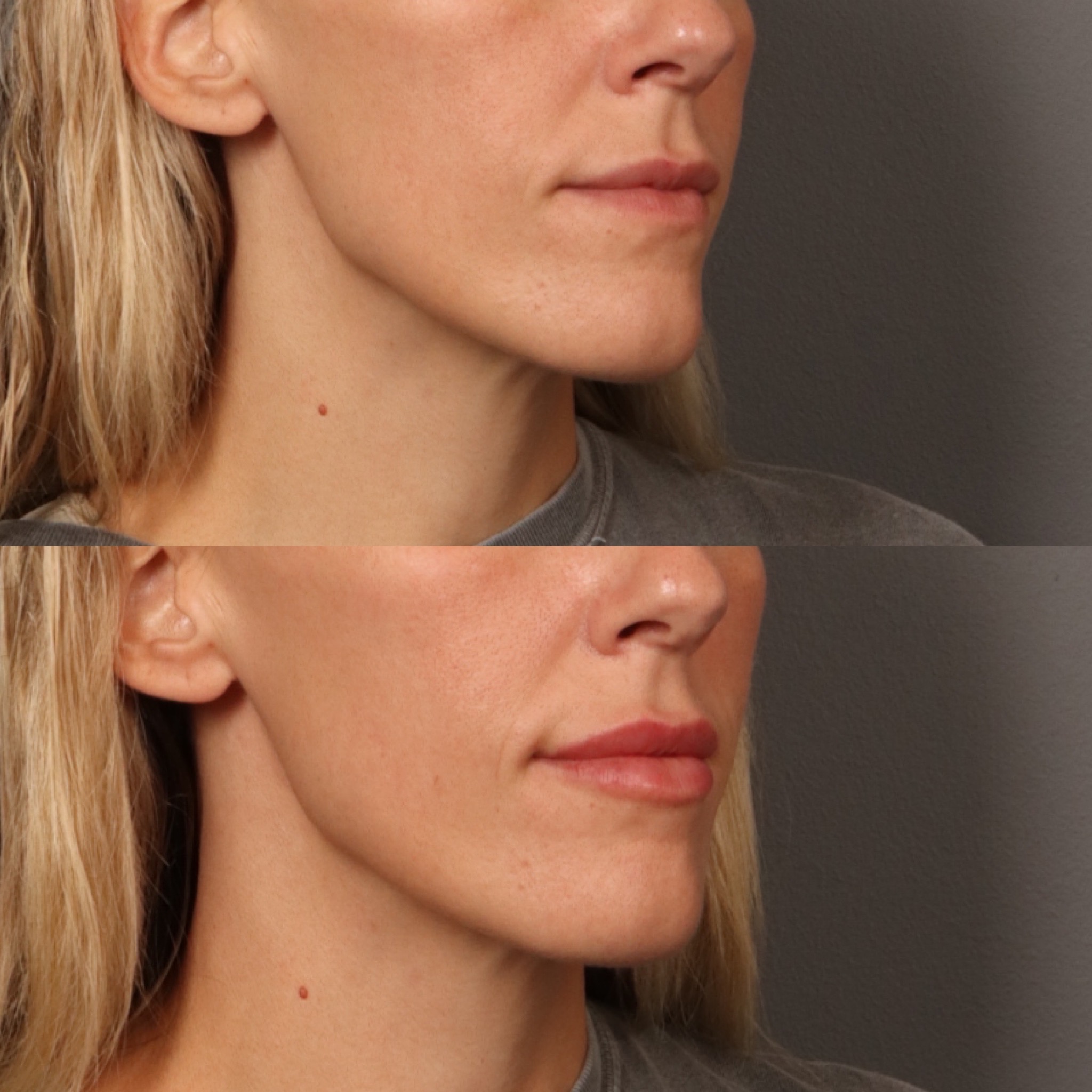 Lip Filler 3 Marge Image