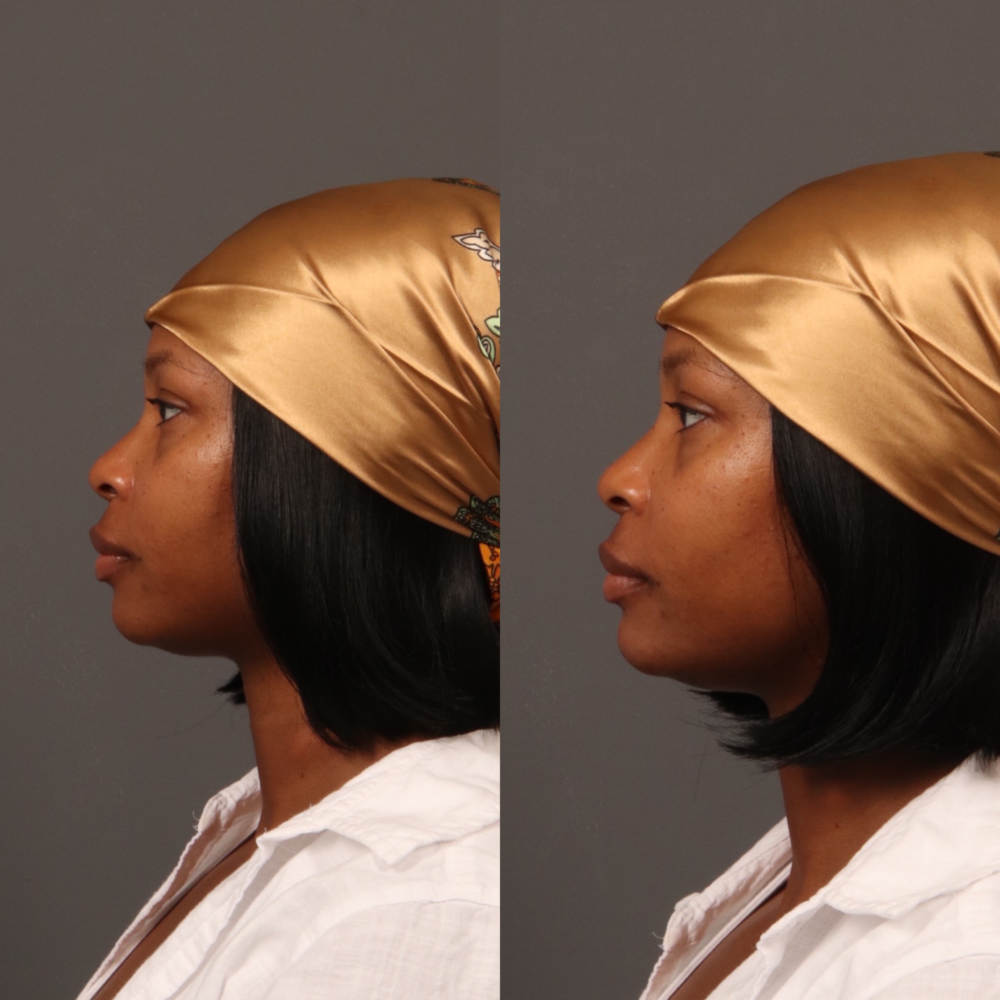 Chin Filler 1 Marge Image