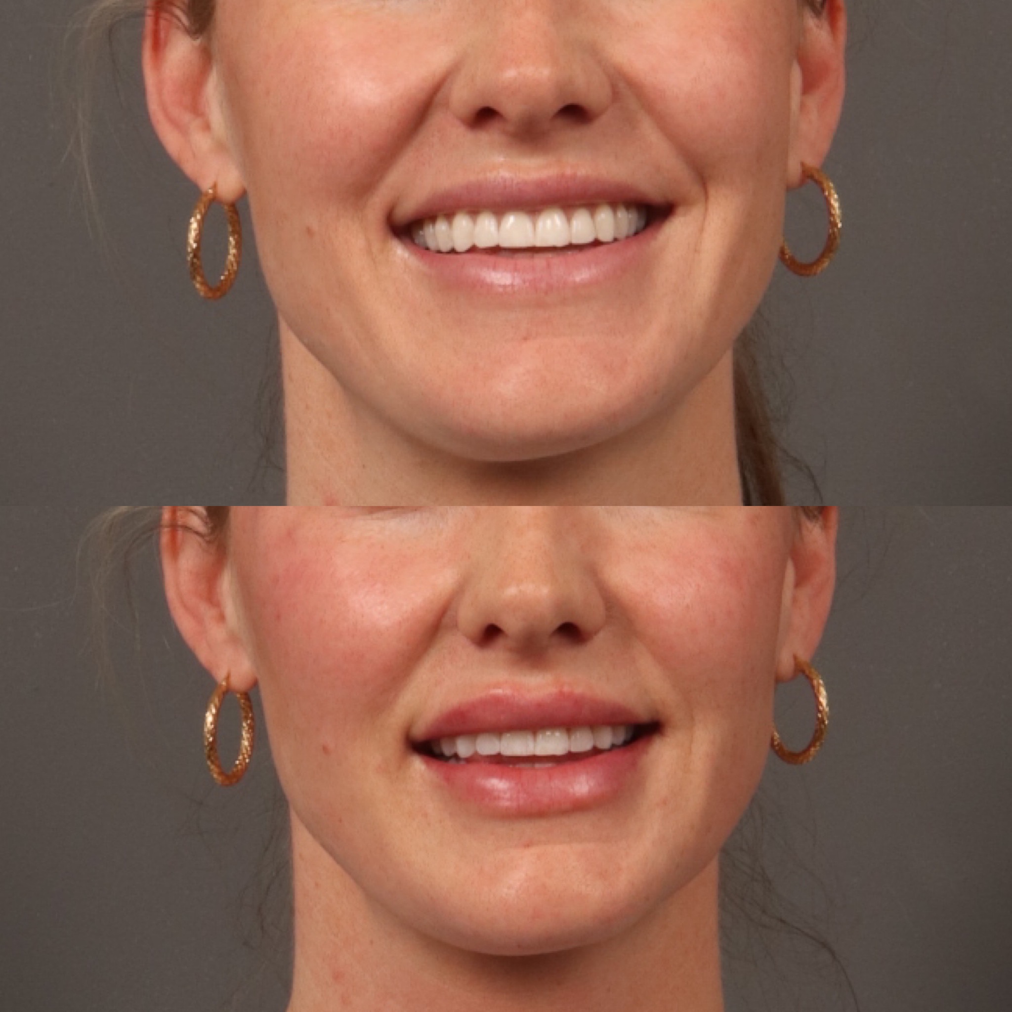 Lip Filler 4 Marge Image
