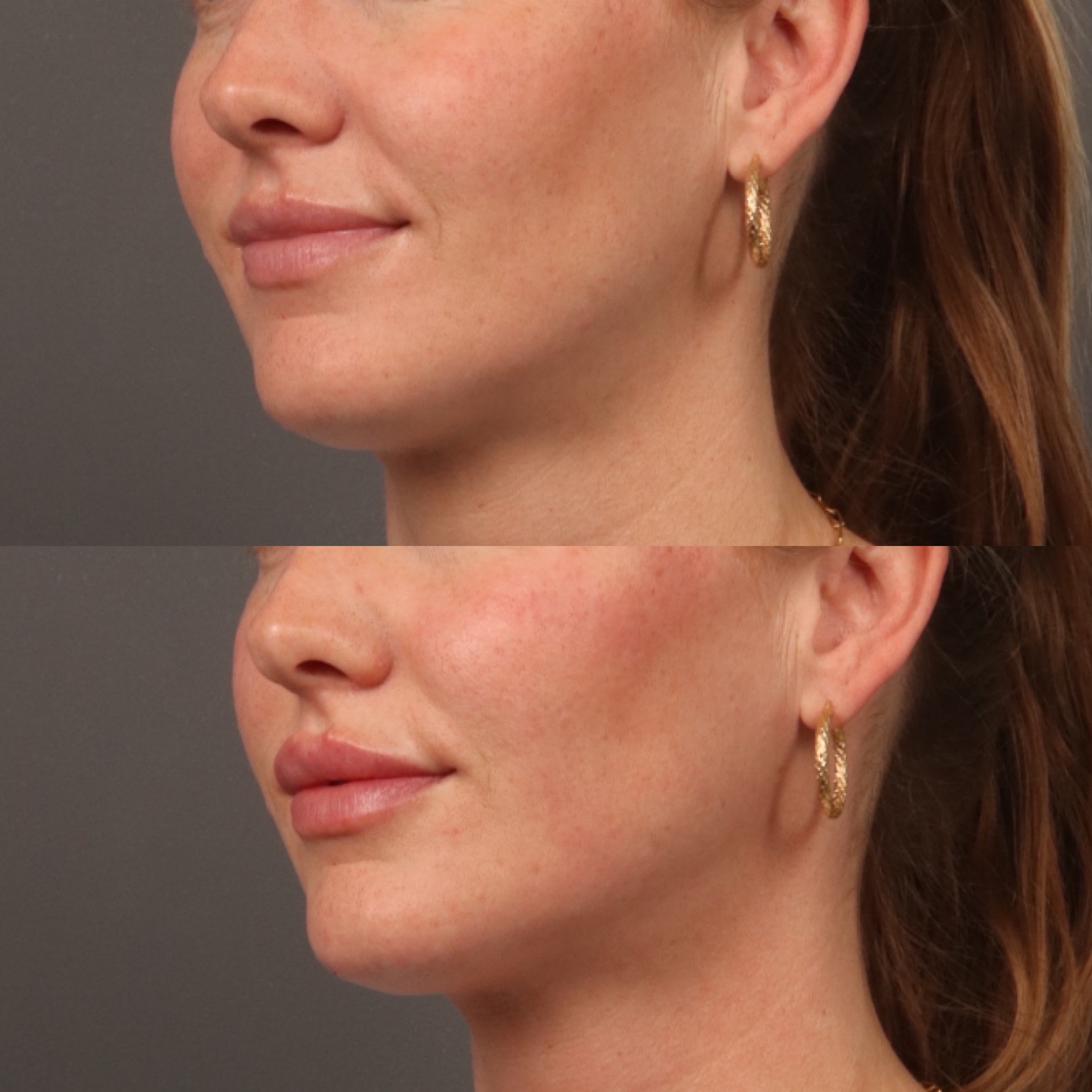 Lip Filler 4 Marge Image