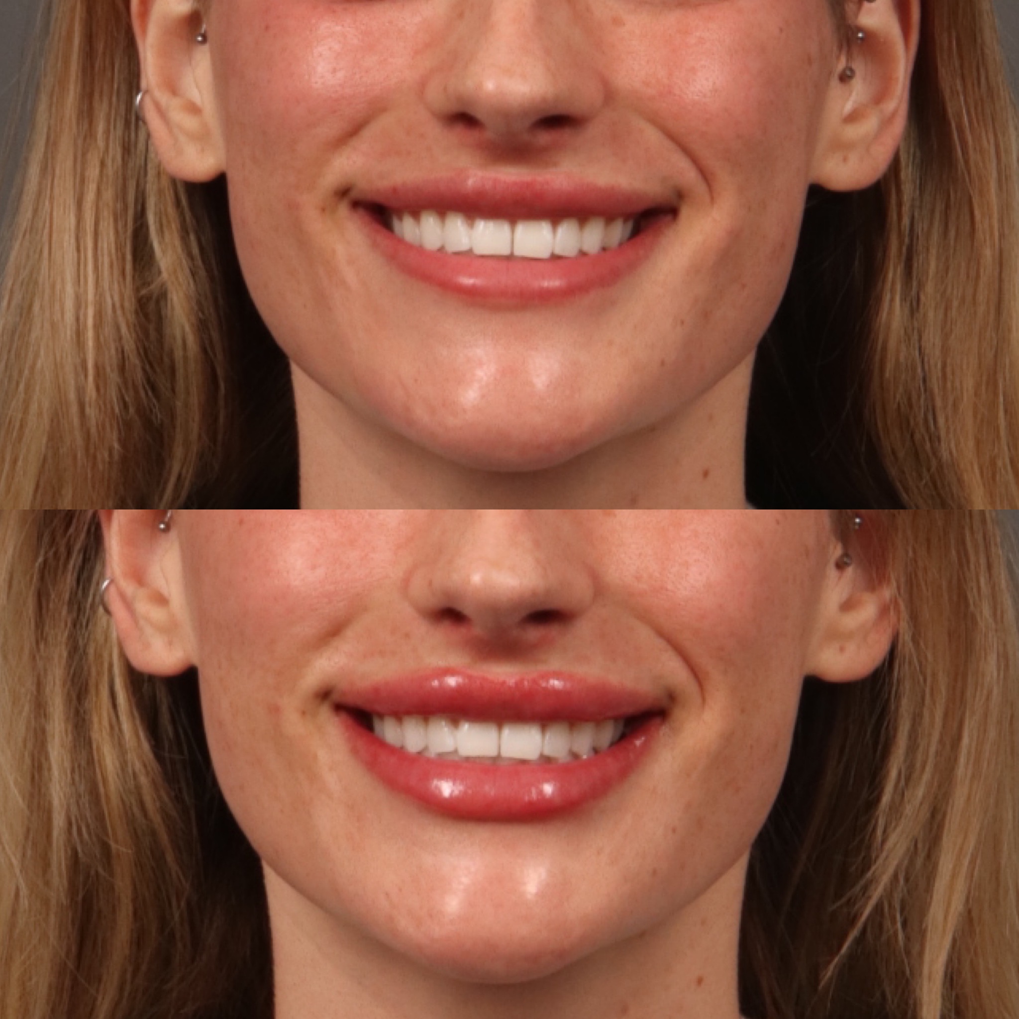 Lip Filler 5 Marge Image