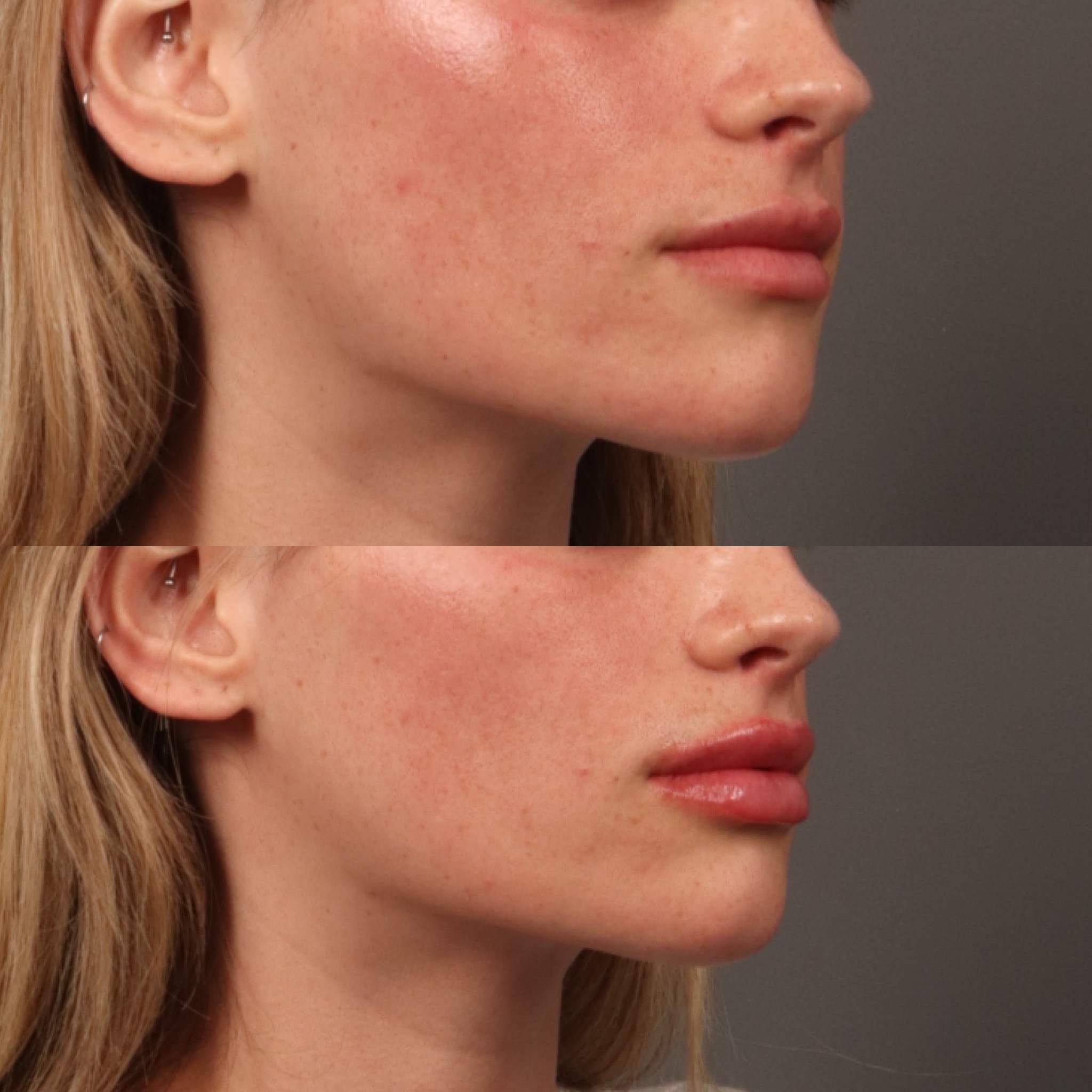 Lip Filler 5 Marge Image