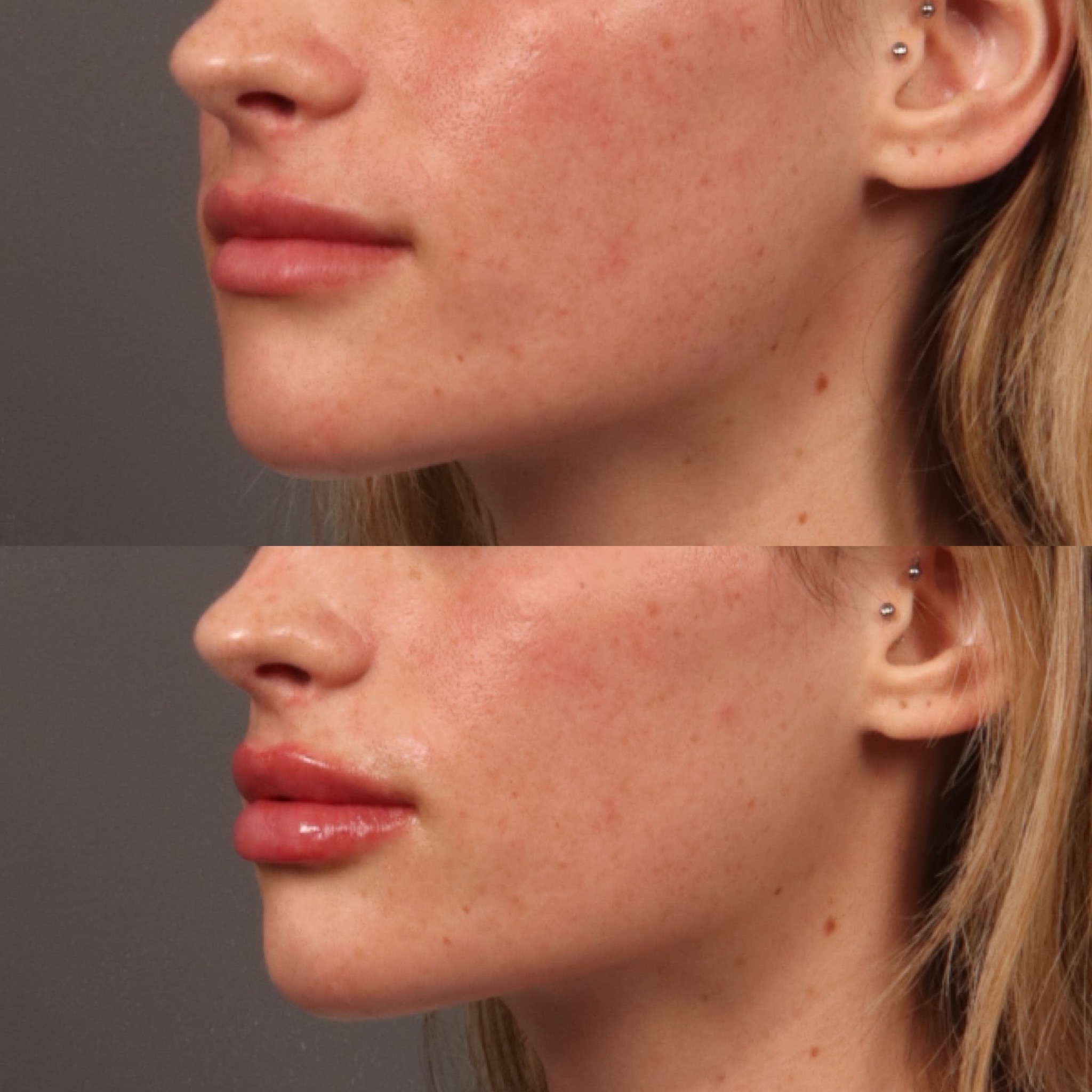 Lip Filler 5 Marge Image