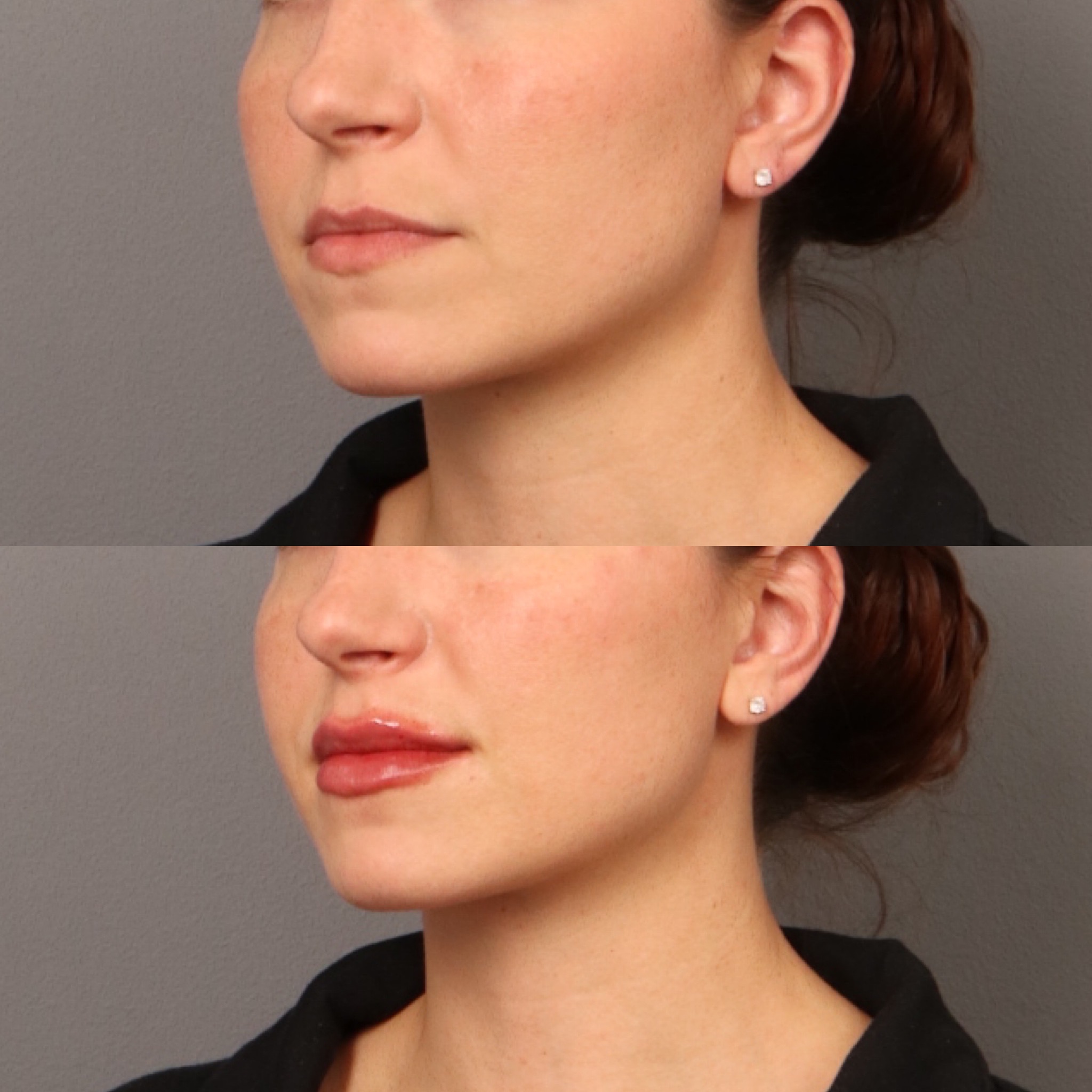 Lip Filler 6 Marge Image
