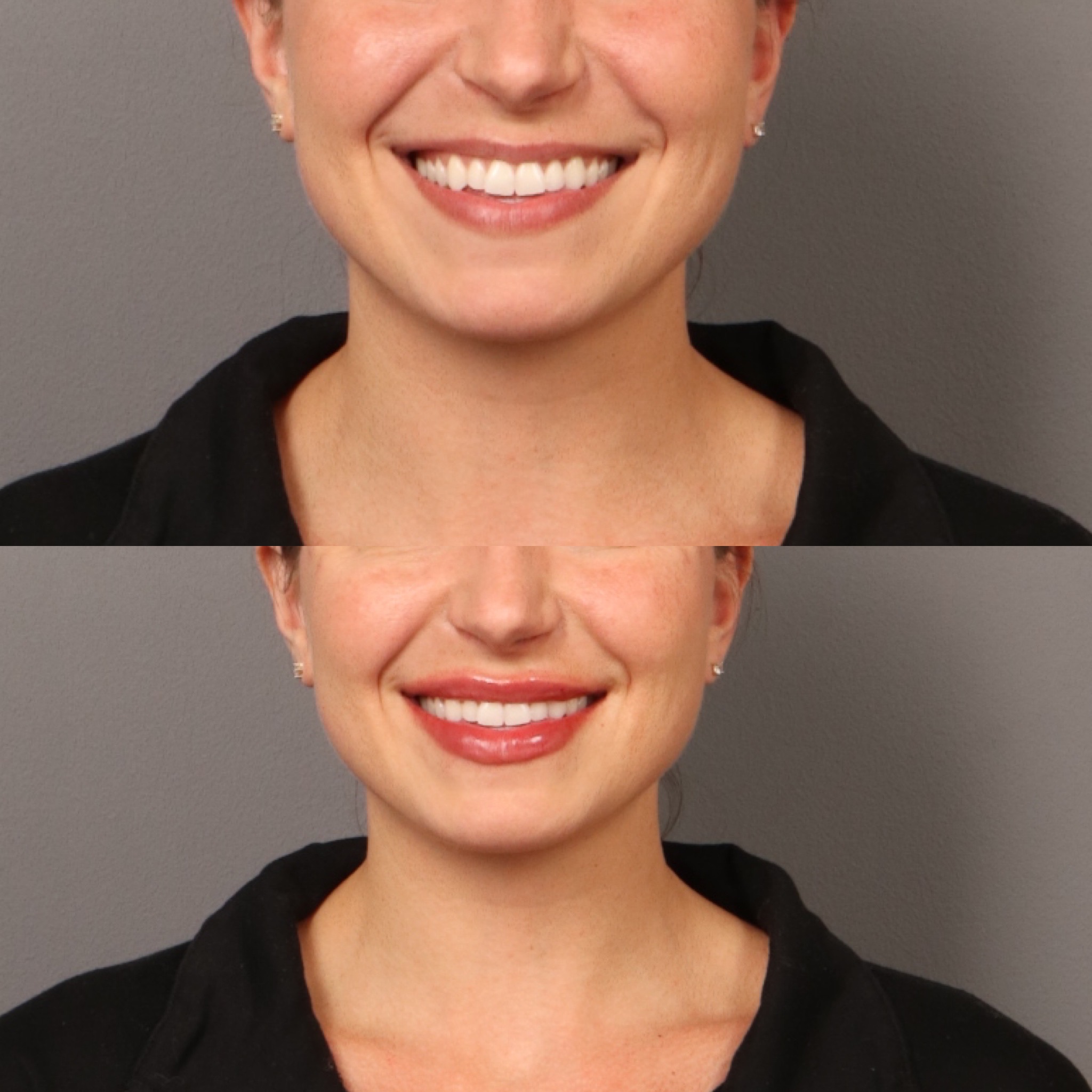 Lip Filler 6 Marge Image