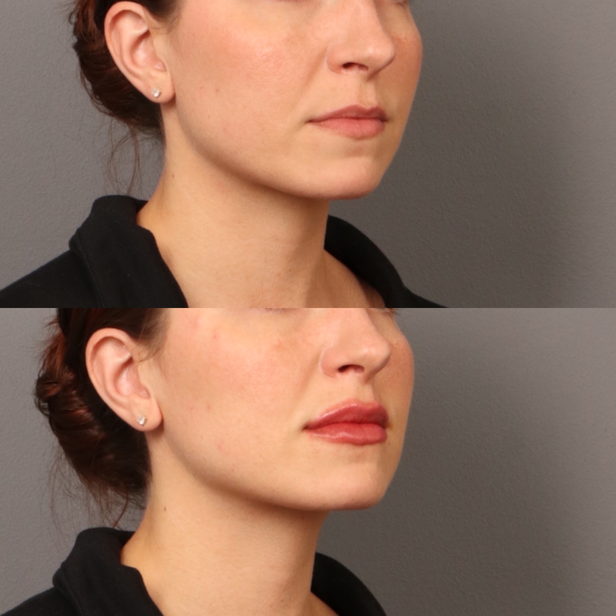 Lip Filler 6 Marge Image