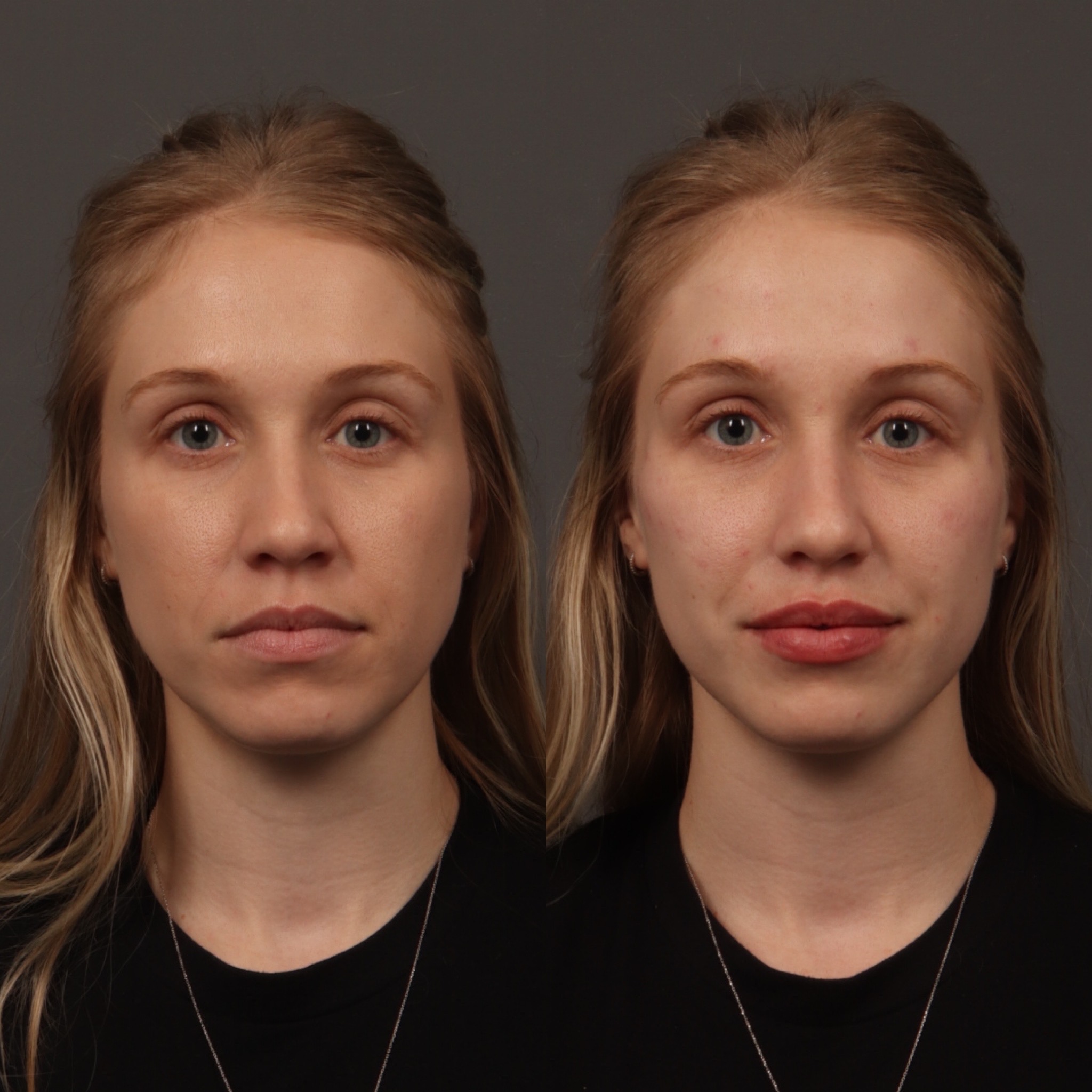 Cheek Filler 3 Marge Image