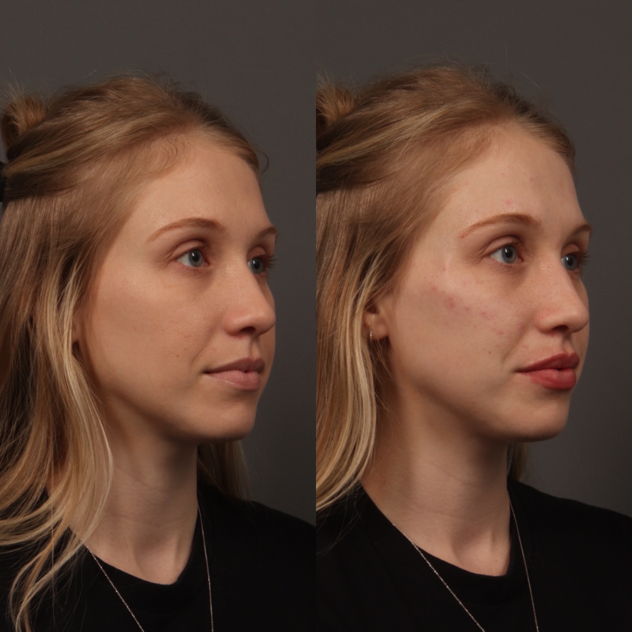 Cheek Filler 3 Marge Image