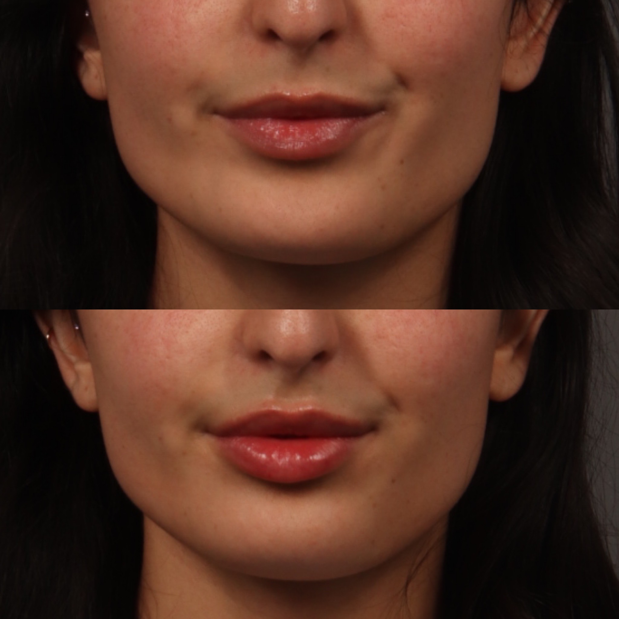 Lip Filler 8 Marge Image
