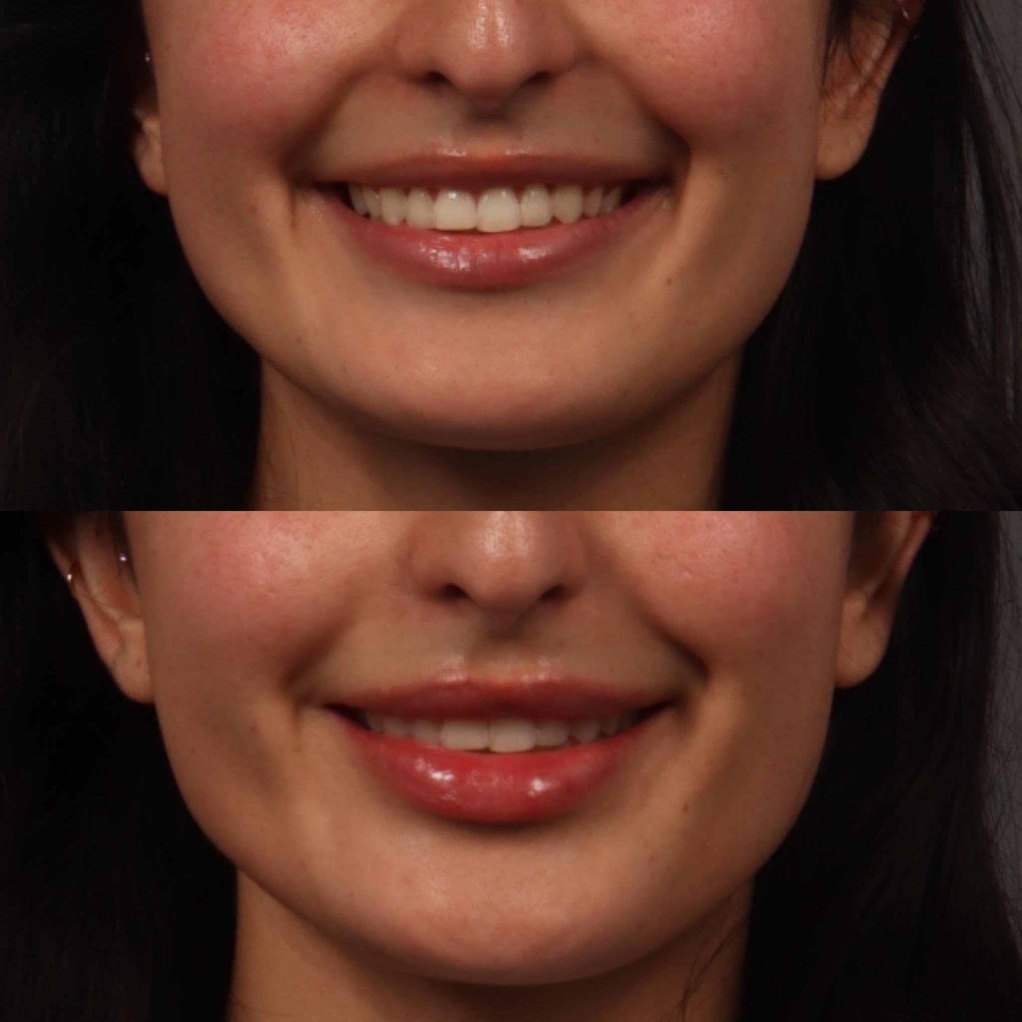 Lip Filler 8 Marge Image