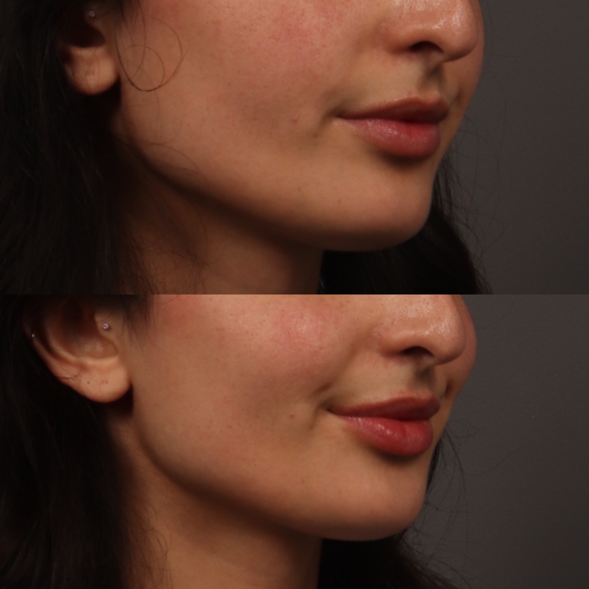 Lip Filler 8 Marge Image