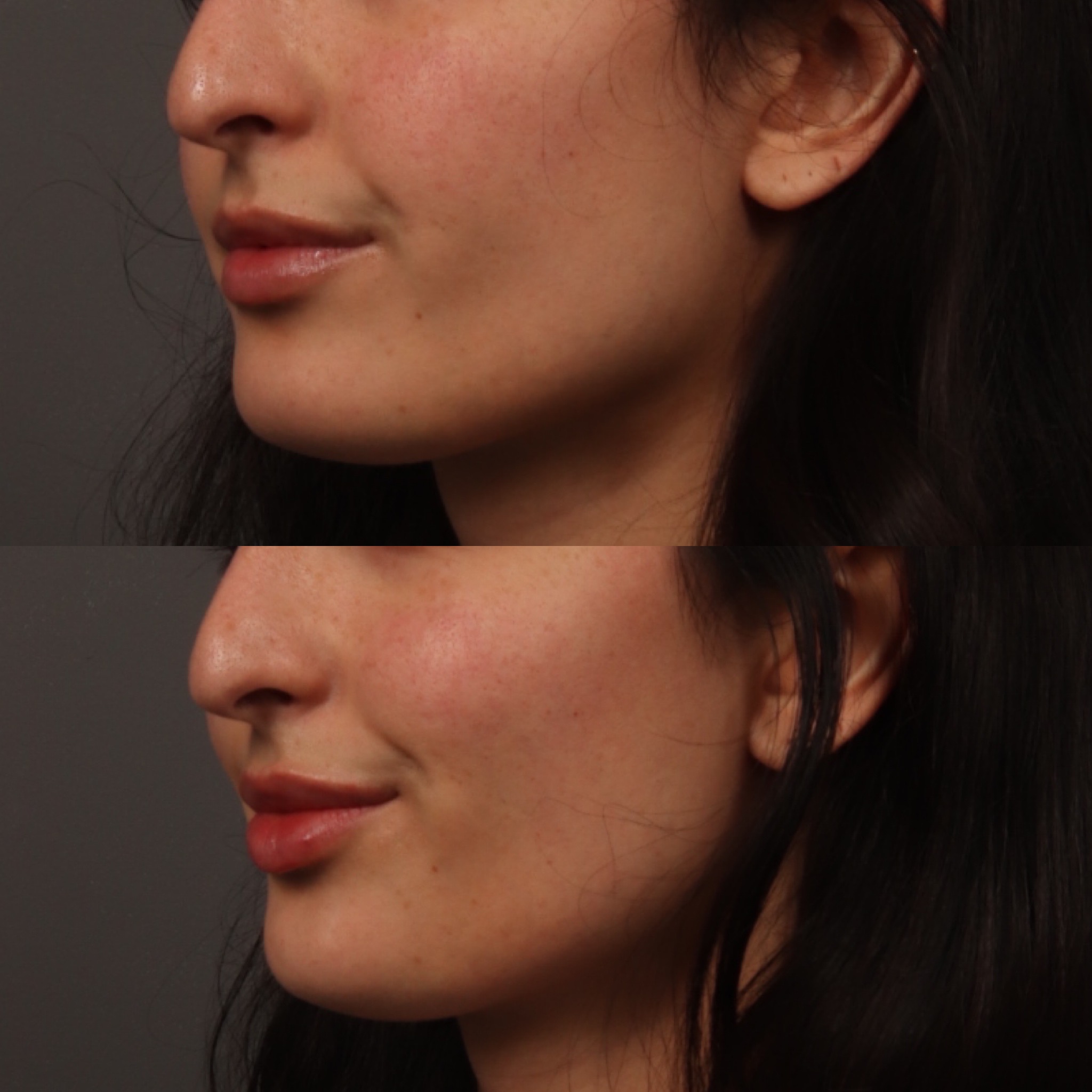 Lip Filler 8 Marge Image