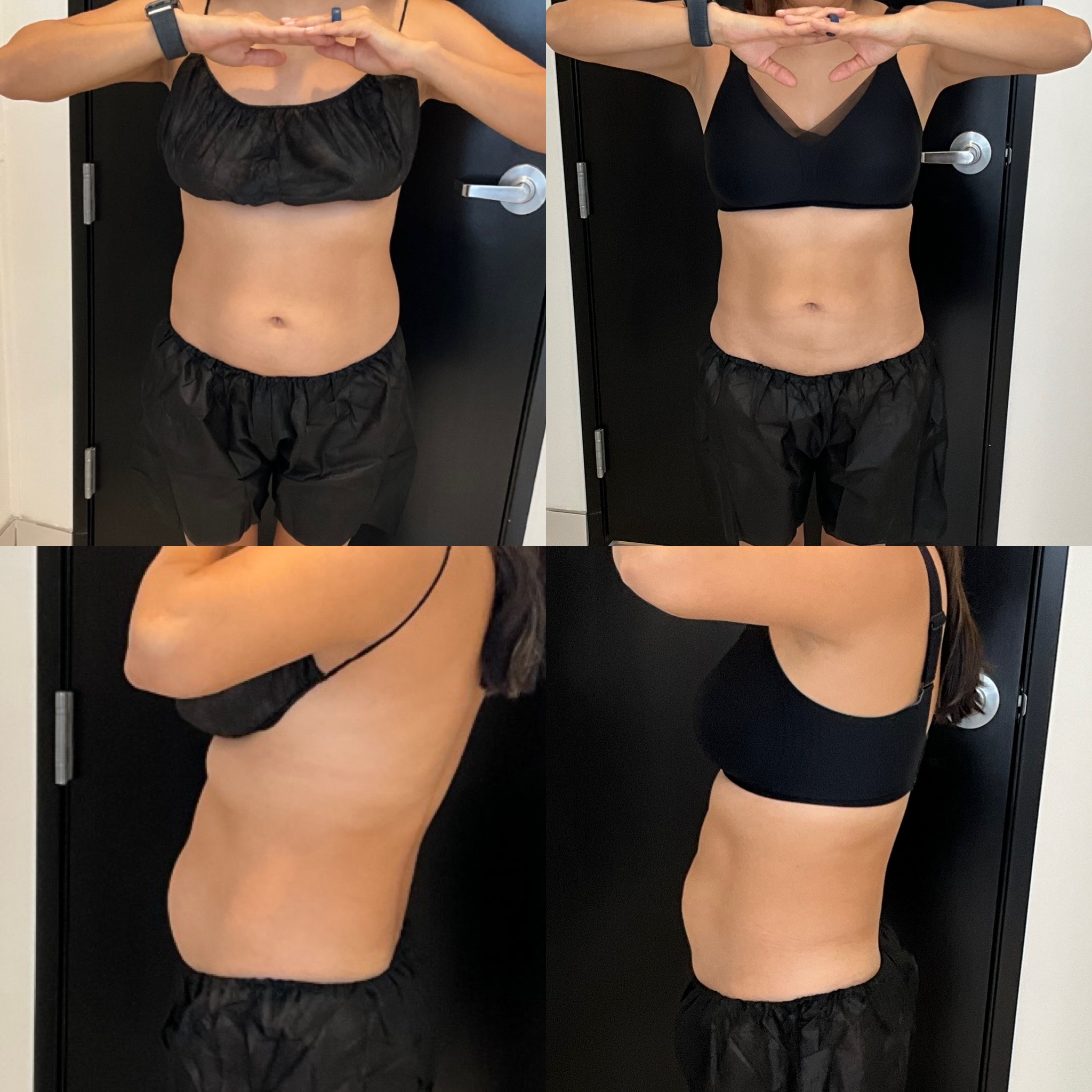 CoolSculpting 1 Marge Image