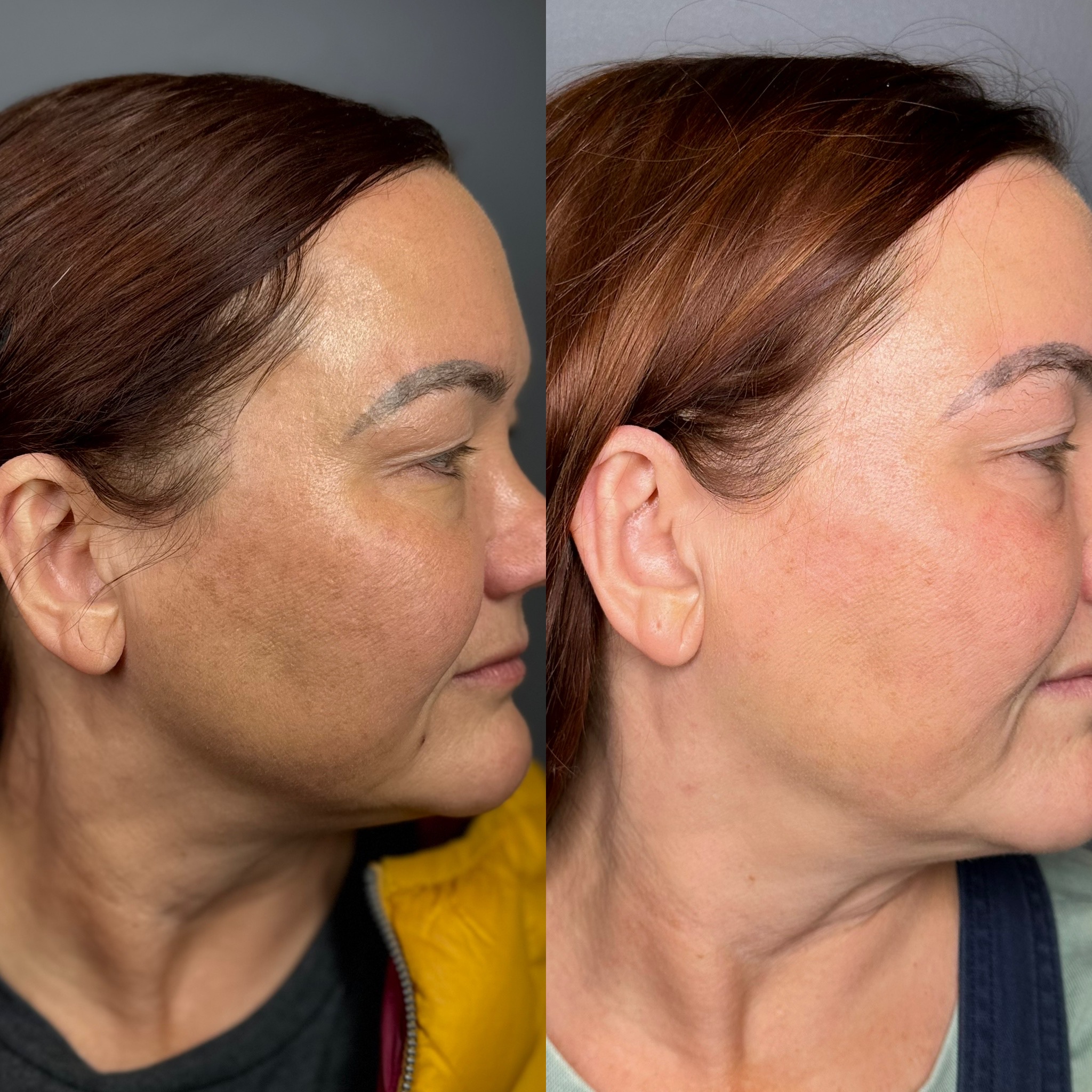 BBL + Perfect Derma Peel 1 Marge Image
