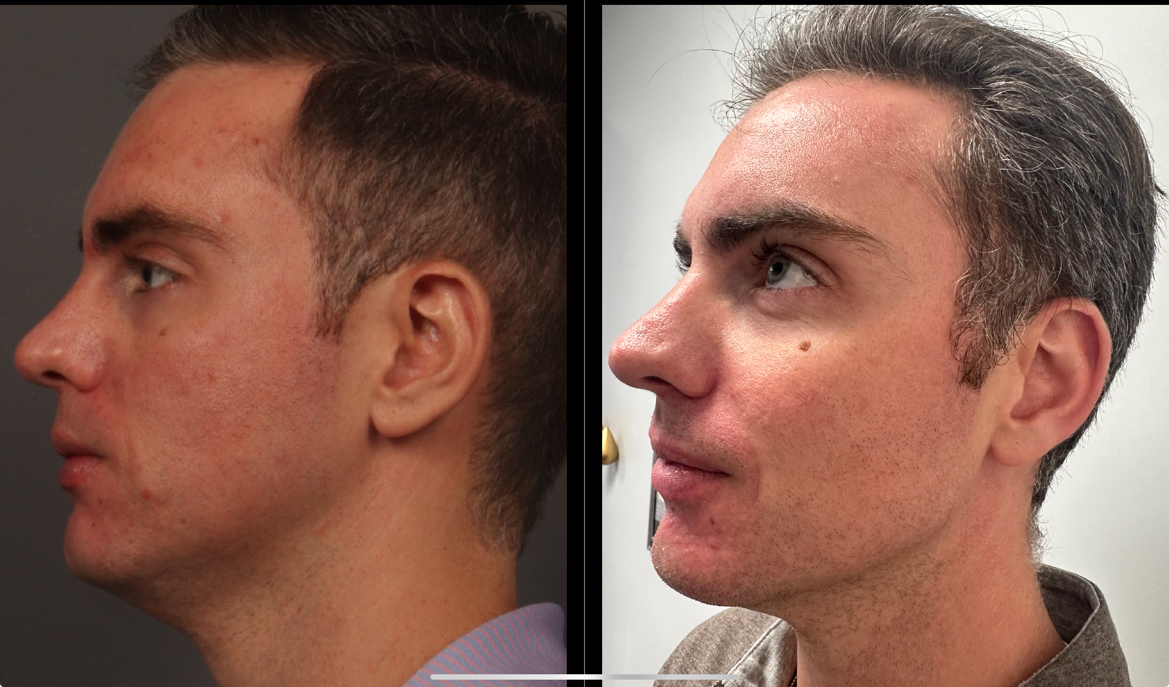 Botox + Cheek Filler + Chin Filler + Jaw Filler + Skincare Marge Image