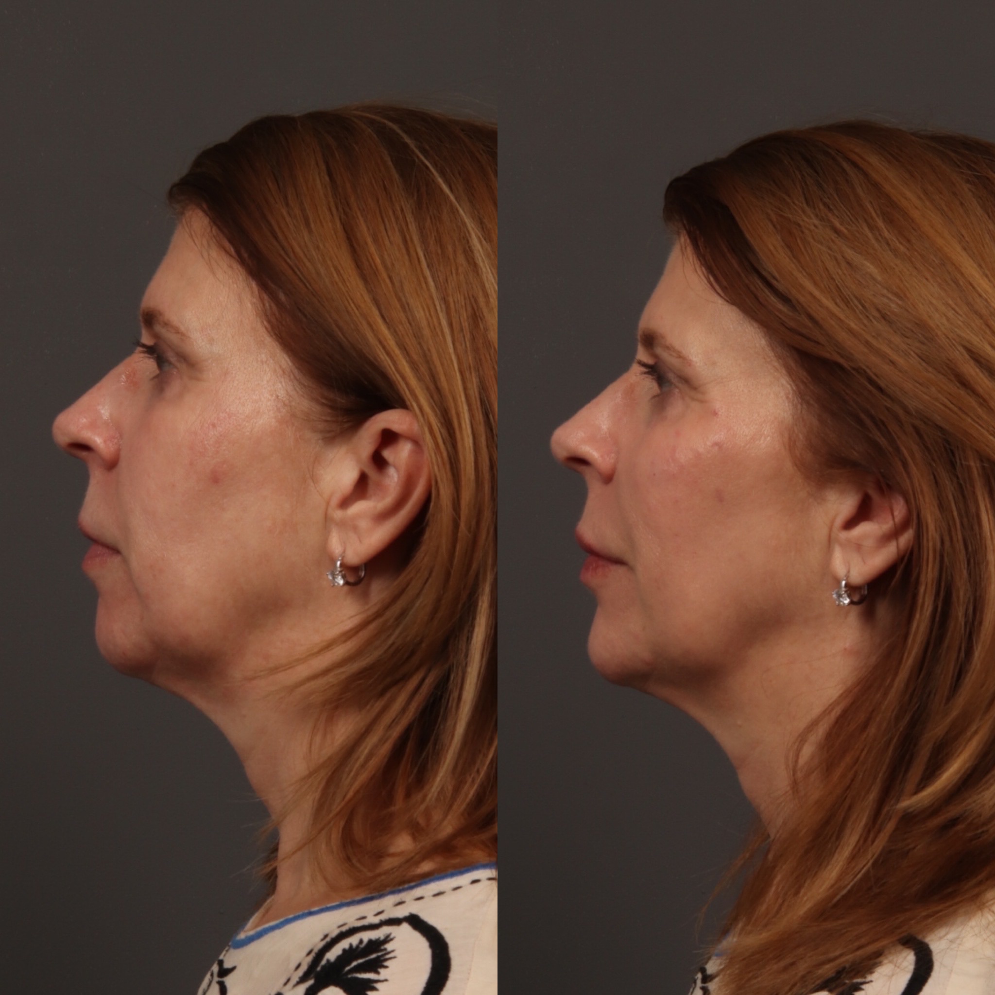 Mid Face Filler + Jaw Filler + Lip Filler + Chin Filler 11 Marge Image