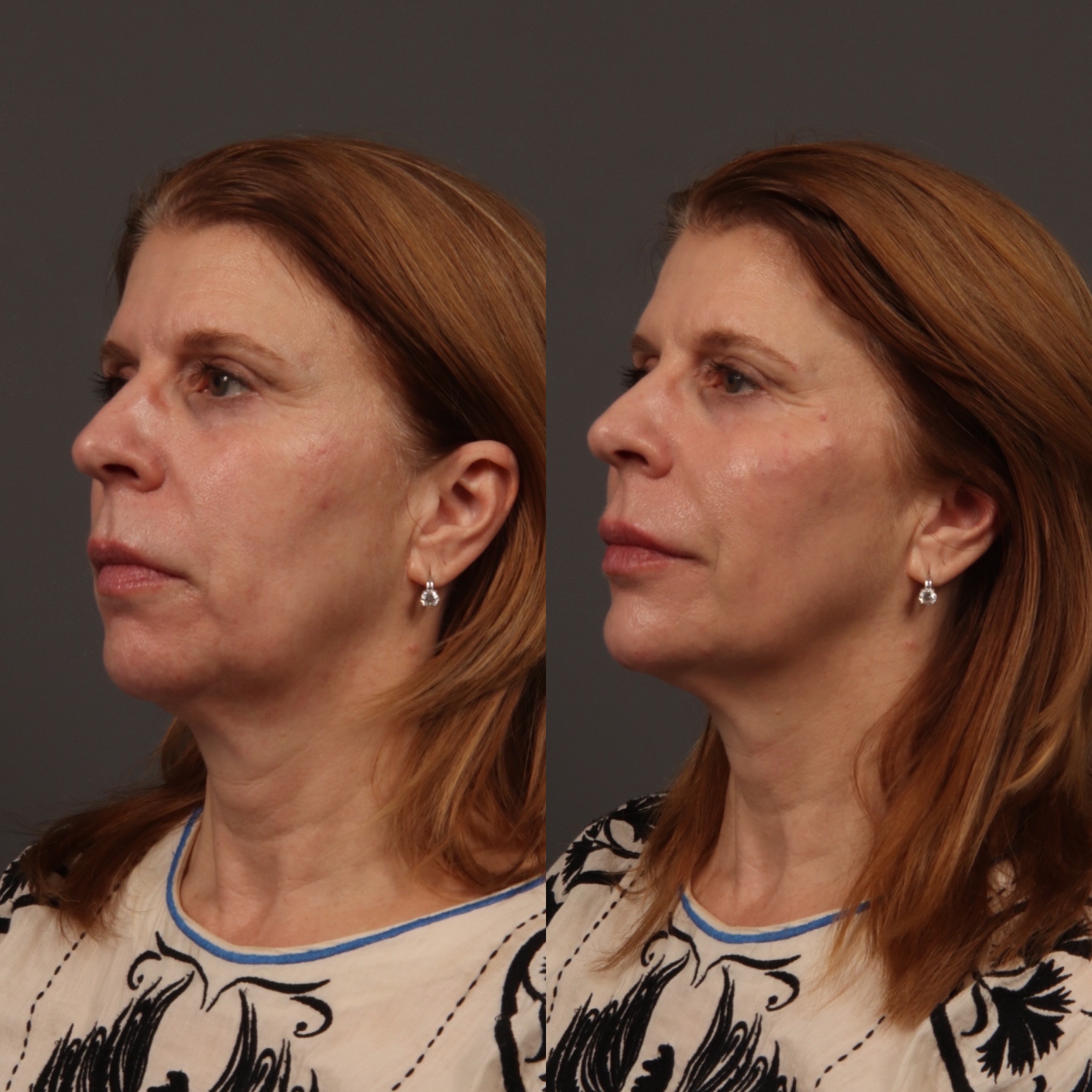 Mid Face Filler + Jaw Filler + Lip Filler + Chin Filler 11 Marge Image