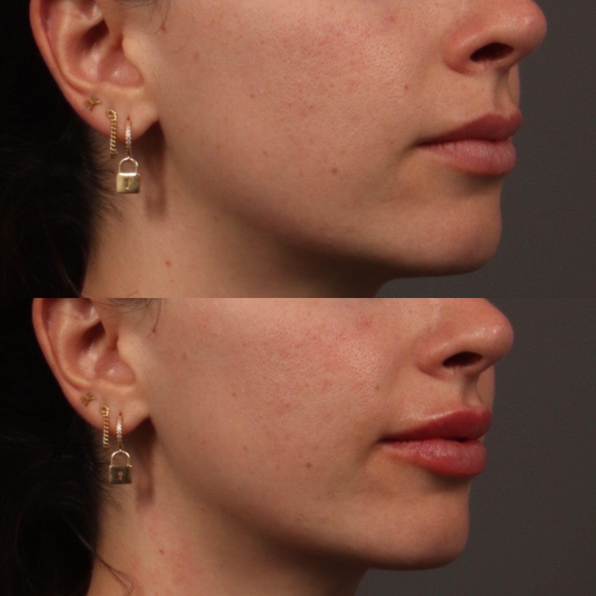Lip Filler 10 Marge Image