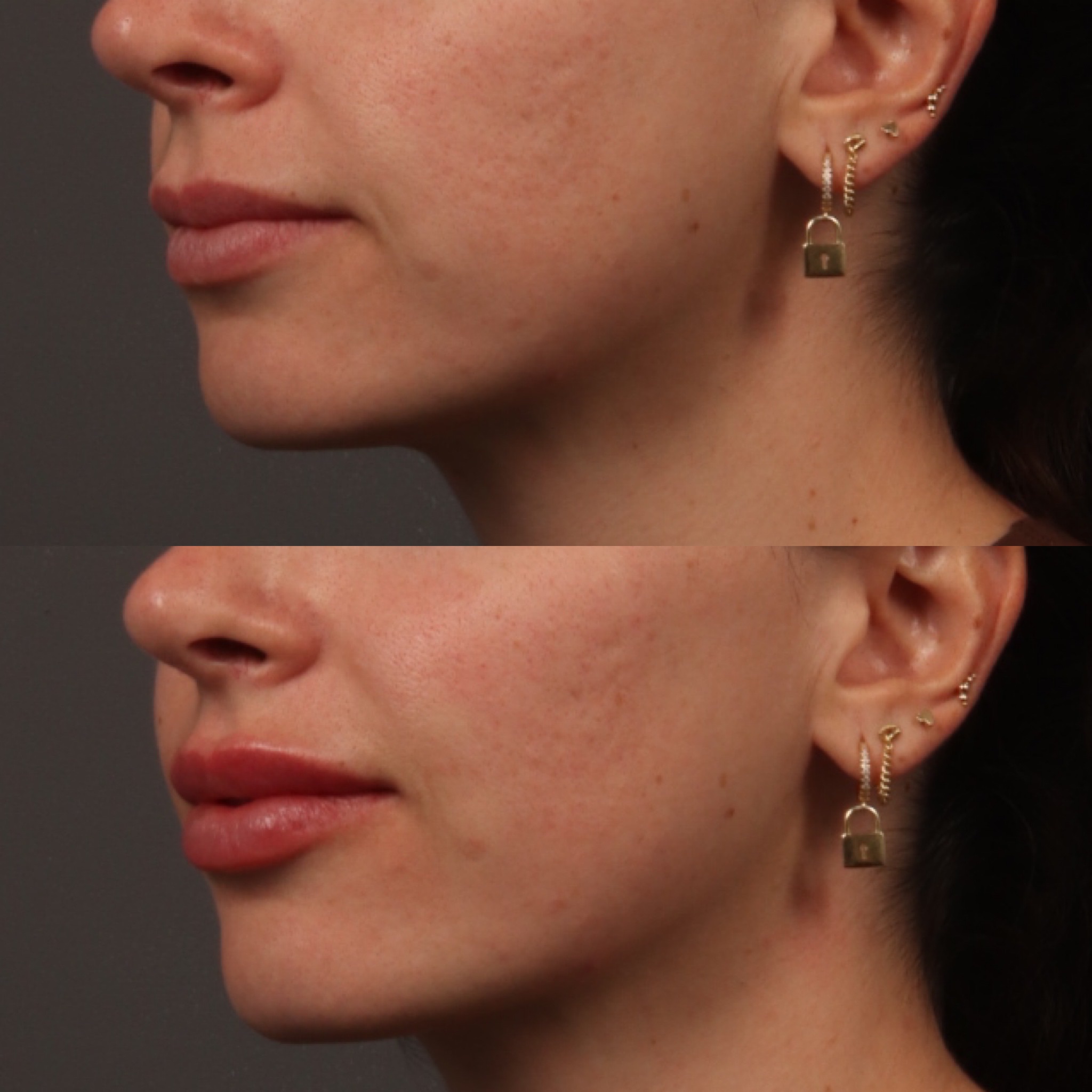 Lip Filler 10 Marge Image