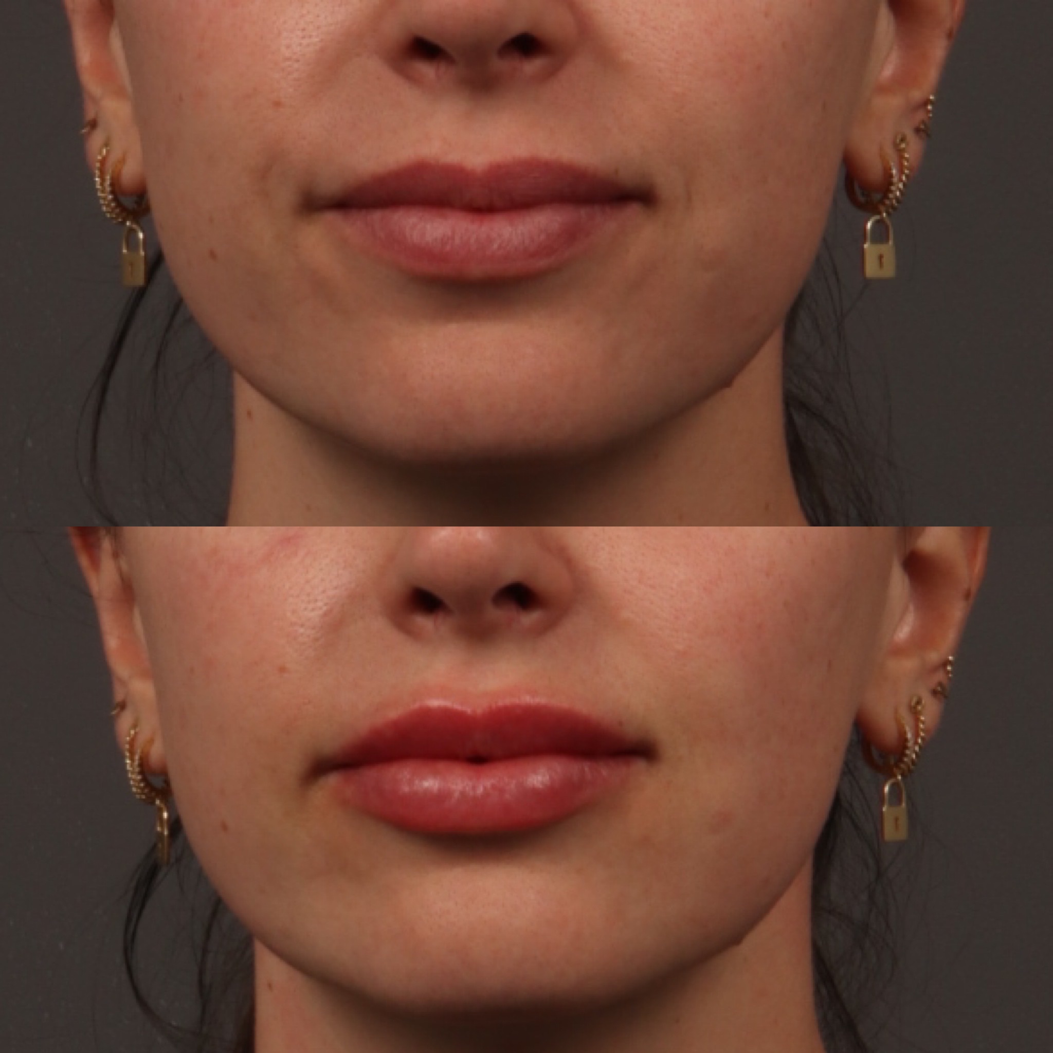 Lip Filler 10 Marge Image