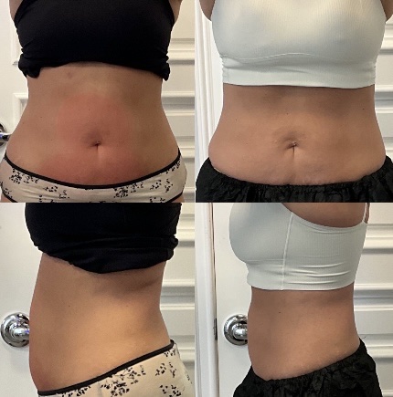 CoolSculpting 2 Marge Image