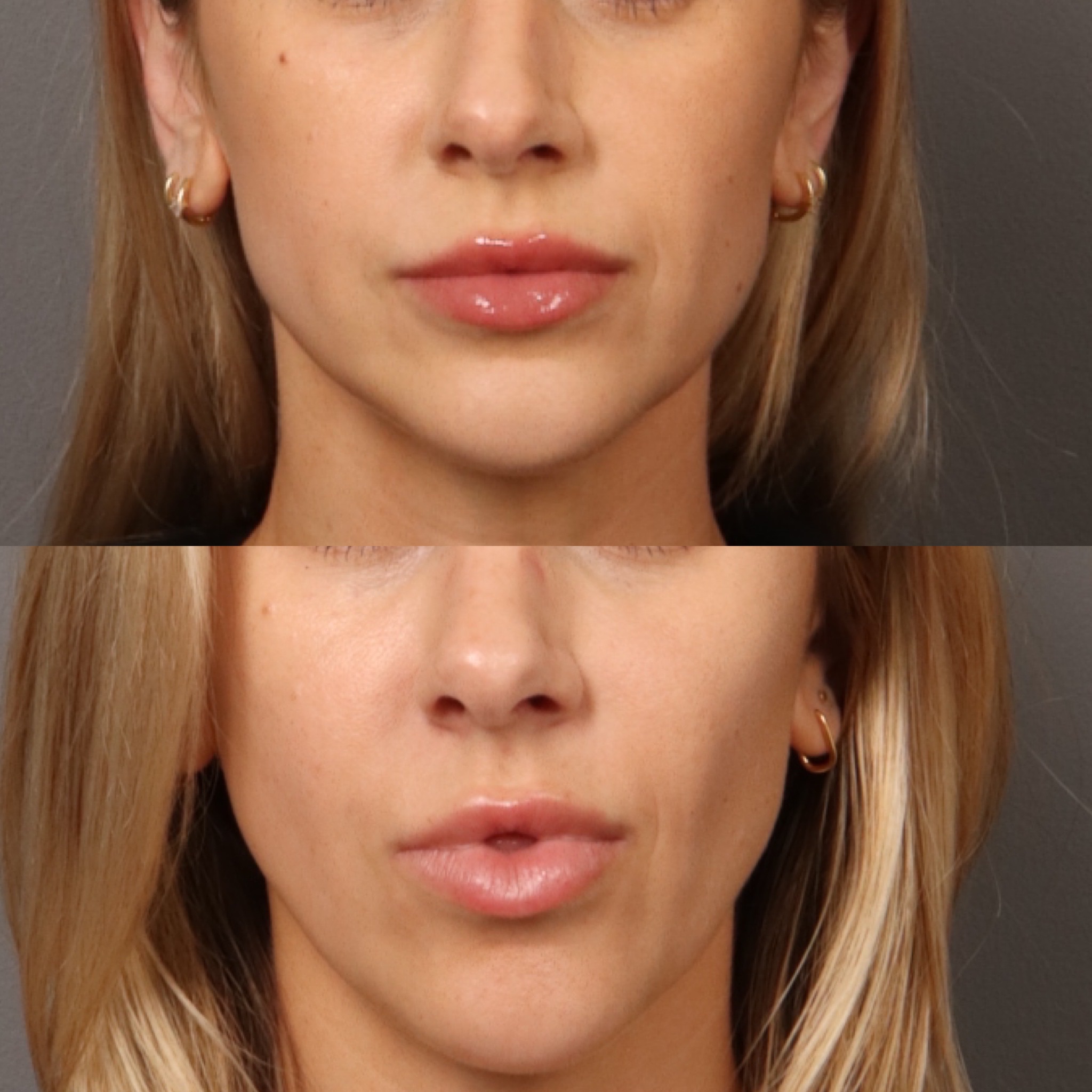 Lip Filler + Mid Face Filler 9 Marge Image