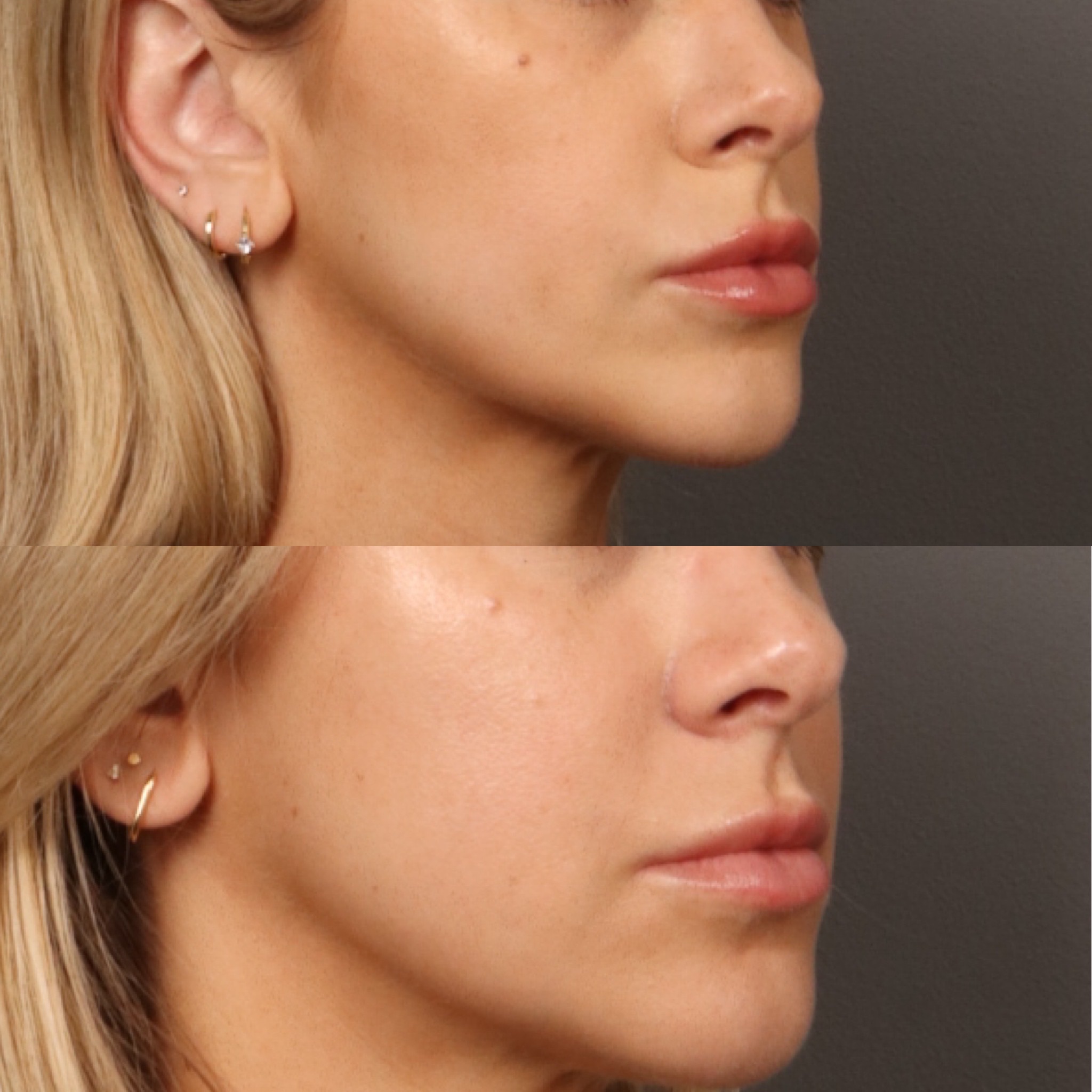 Lip Filler + Mid Face Filler 9 Marge Image