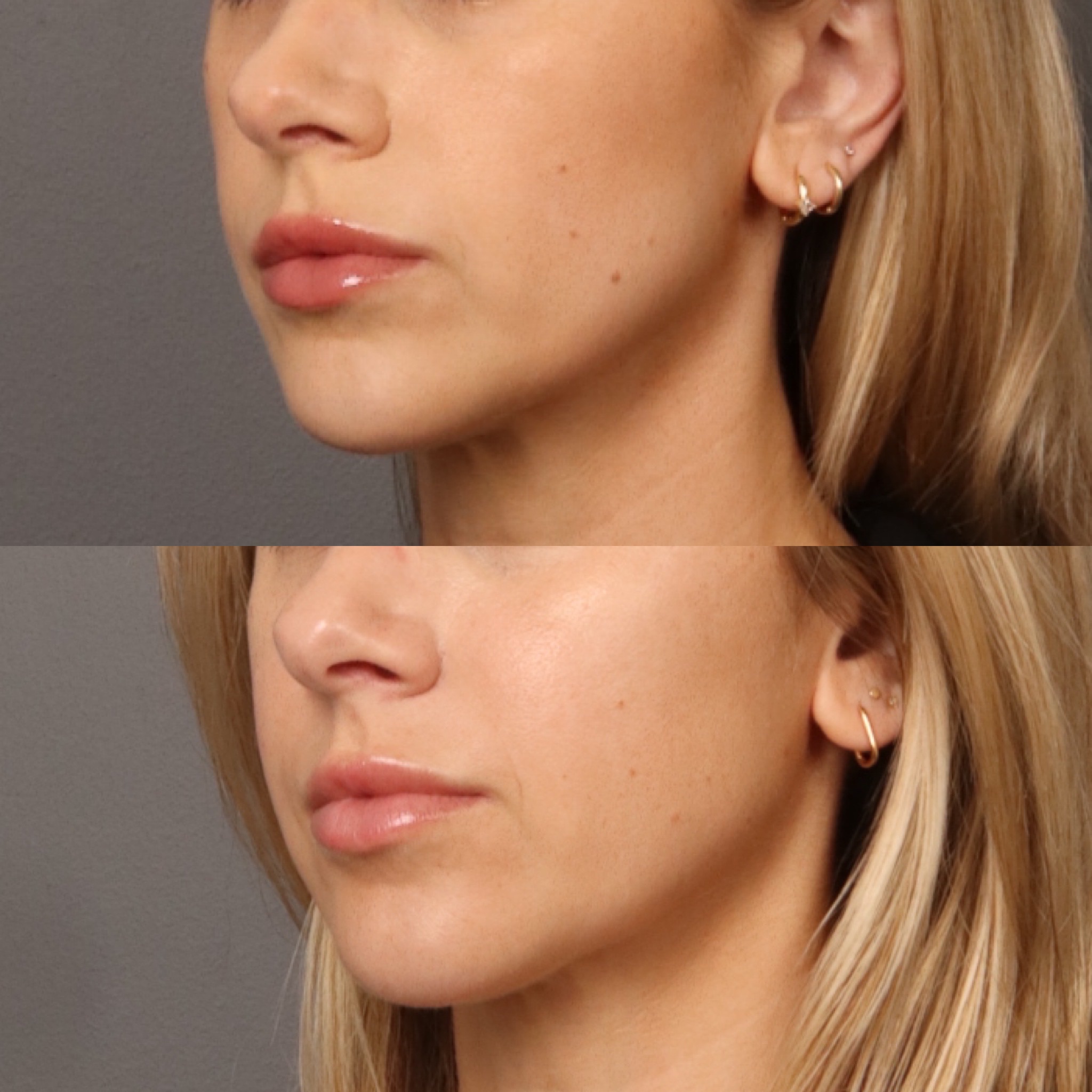 Lip Filler + Mid Face Filler 9 Marge Image